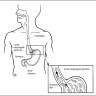 Гастроэзофагеальная рефлюксная болезнь (желудочно-пищеводный рефлюкс или ЖПР)