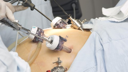 Лапароскопия опухоли почки | | "АГАПЕ" Медицинский центр в Люблино