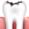 Почему образовываются дырки в зубах